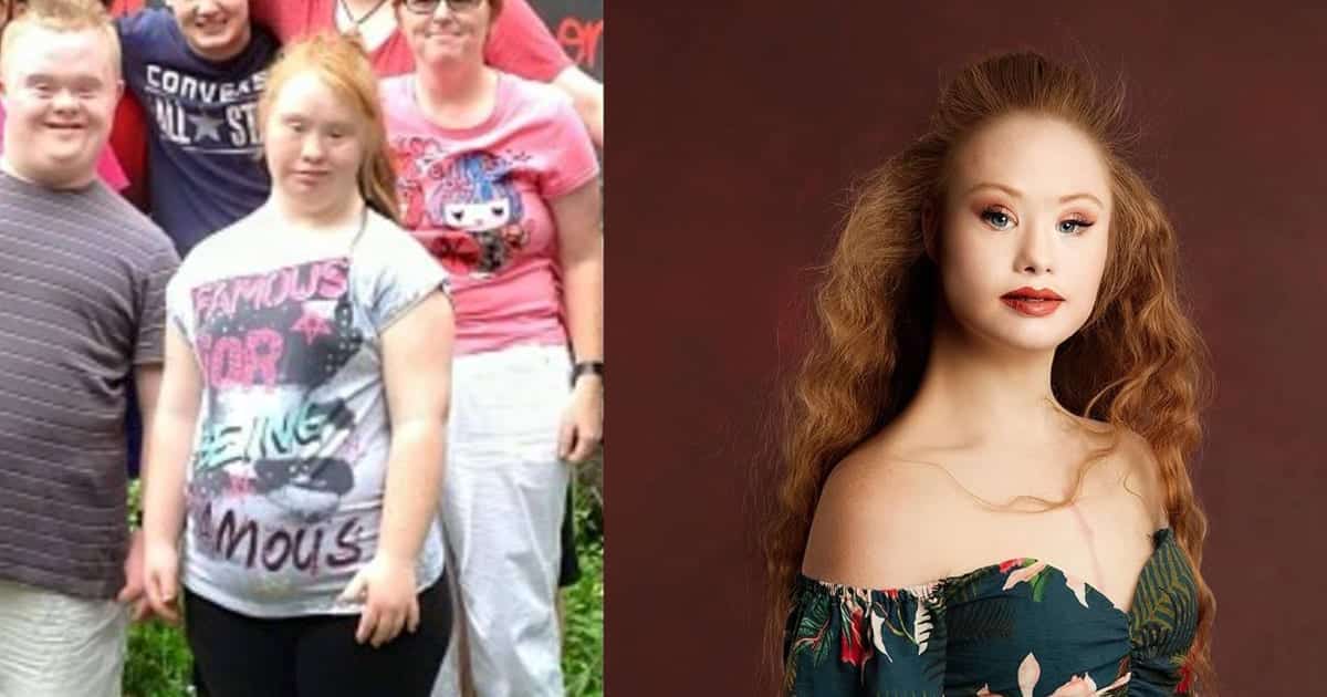 Girl with Down syndrome, loses over 40 pounds and gets into modelling.