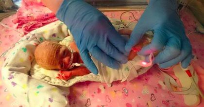 Baby Weighs 1.1 Lbs – Doctor Uses Sandwich Bag To Save Her