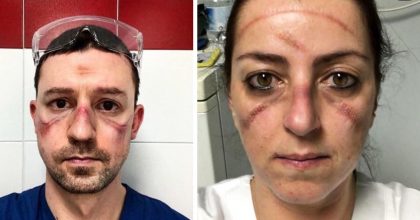 Health care workers share photos of their bruised faces after long shifts wearing protective gear