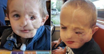 Boy Barely Survives Dog Attack Only To Get Bullied For His Face Scars.