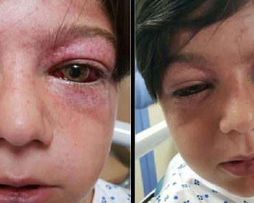 Mom has a warning for other parents after playground craze leaves her 11-year-old son “looking like an alien”