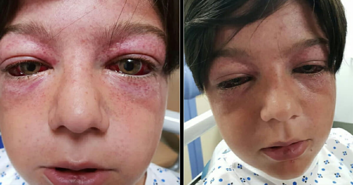 Mom has a warning for other parents after playground craze leaves her 11-year-old son “looking like an alien”