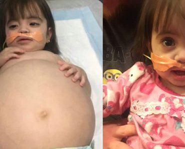 Little girl who looked 8 months’ pregnant because of deadly disease is saved thanks to dad’s kidney donation