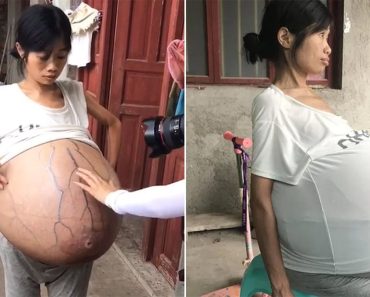 Woman’s belly weights 44 pounds and still growing, doctors fail to learn the reason why