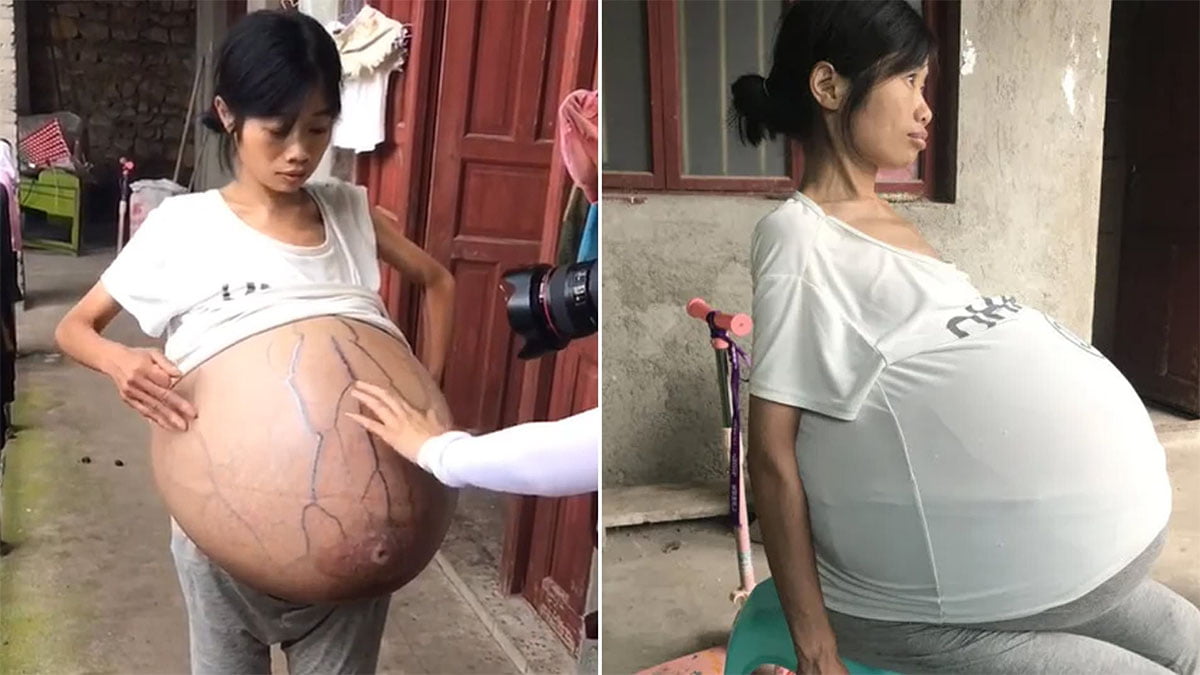 Woman’s belly weights 44 pounds and still growing, doctors fail to learn the reason why