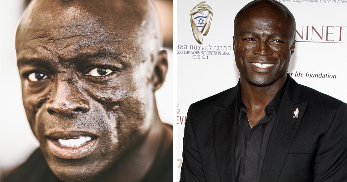 Seal opens up about his facial scars which became his trademark over the years