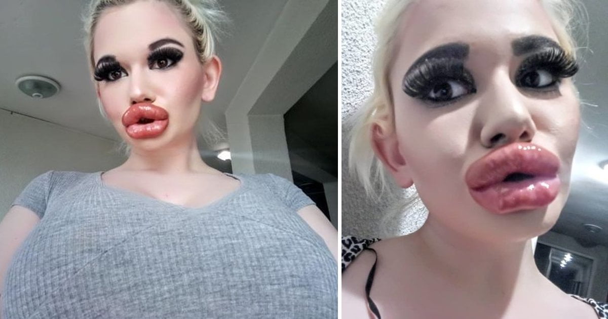 Woman Receives 17 Injections To Have Biggest Lips In The World