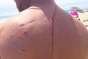 Shark Attack Ends Up Saving Man’s Life