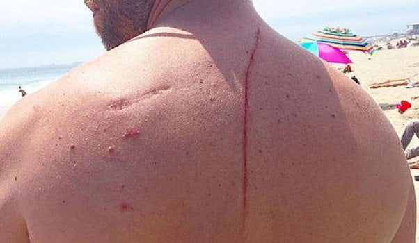 Shark Attack Ends Up Saving Man’s Life