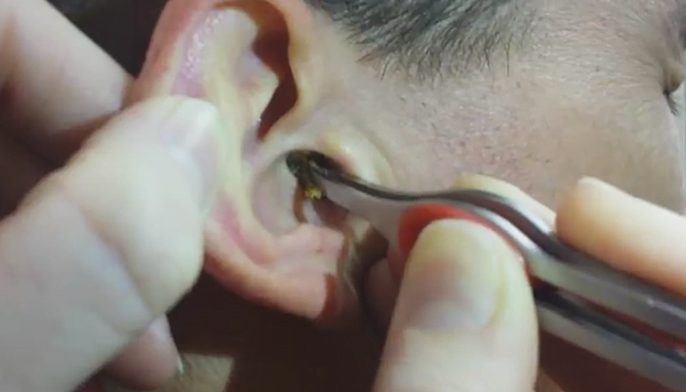 Man Helps His Friend With His Ear Issue.