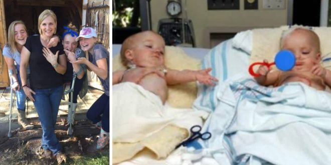 Formerly Conjoined Twins Say Their Life As Teens Is Normal Almost A Decade After Surgery