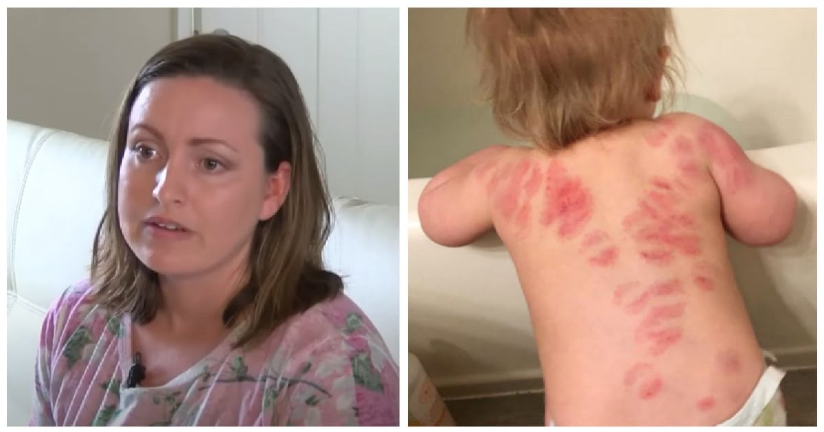 25 bloody bite marks all over baby’s body: Mom’s horrific discovery after picking her girl up from daycare