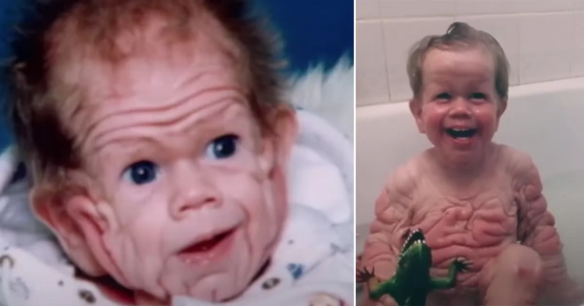 Tomm Tennent: The unique baby born with enough skin to cover the body of a five-year-old child