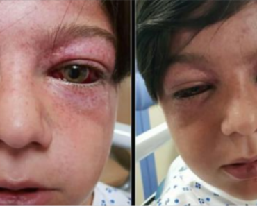 Playground craze leaves 11-year-old boy “looking like an alien” – mom issues warning for parents