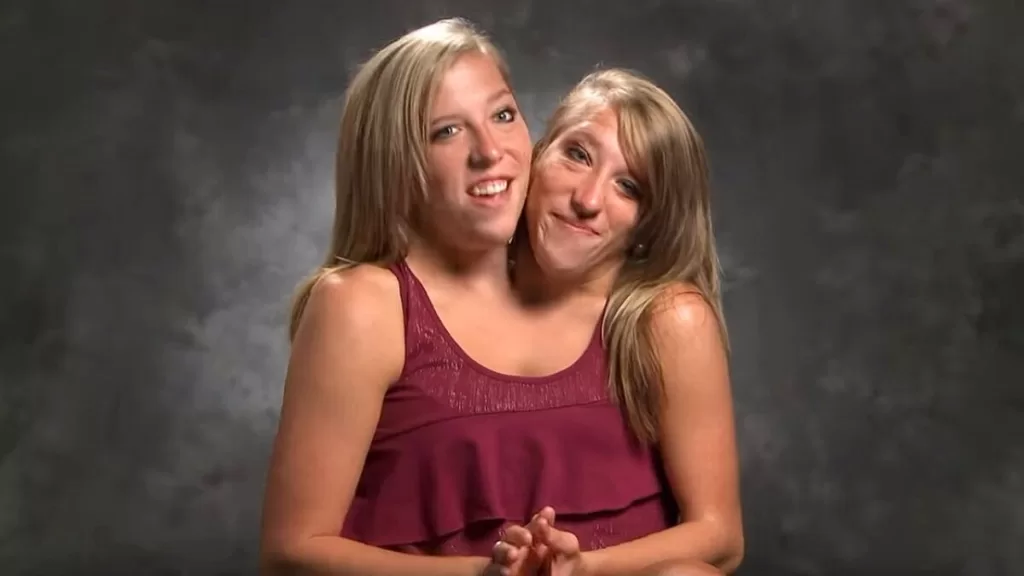 Conjoined Twin Sisters Abby and Brittany Hensel: Where are they Now?