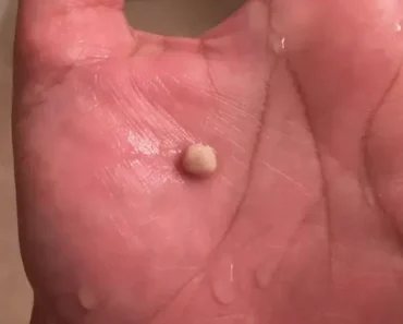 Everything you need to know about tonsil stones, the weird growths that look like pimples in your throat