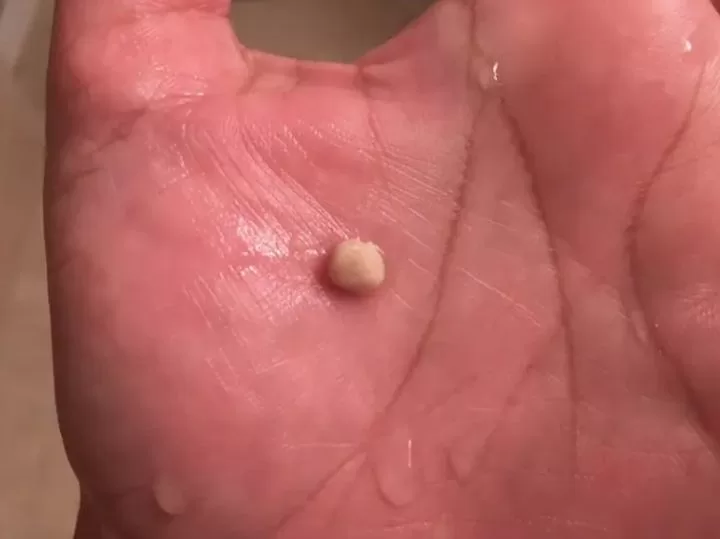 Everything you need to know about tonsil stones, the weird growths that look like pimples in your throat