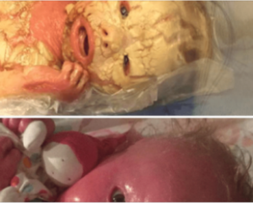 Doctors perform an emergency C-section and give birth to a baby with a rare skin disease.