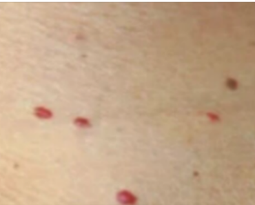 Red dots on your skin: Causes and what they could mean