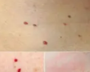 RED DOTS ON YOUR SKIN: CAUSES AND WHAT THEY MIGHT REPRESENT