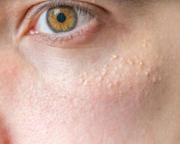 Banish Milia: Those Annoying Little Bumps!