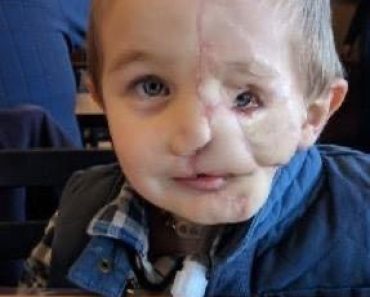 Boy, nearly 7, who lost half his face after being attacked by dogs is called ‘monster’ in public