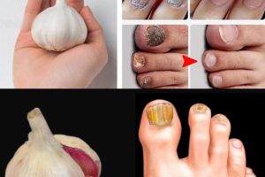 Erase Nail Fungus Naturally: Discover the Power of Garlic