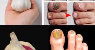 Erase Nail Fungus Naturally: Discover the Power of Garlic