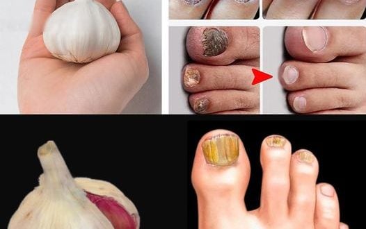 Erase Nail Fungus Naturally: Discover the Power of Garlic