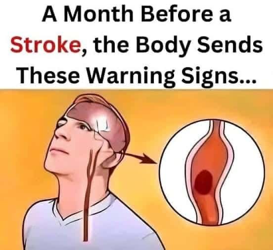 A Month Before a Stroke: Know the Warning Signs