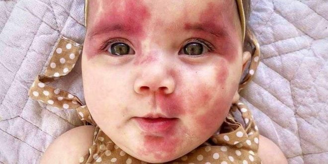 Baby called ‘hideous’ is a gorgeous little girl now