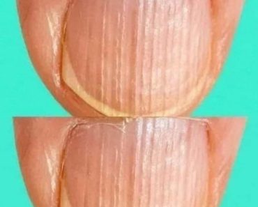 Doctor Reveals 7 Health Issues Hidden in Your Nails