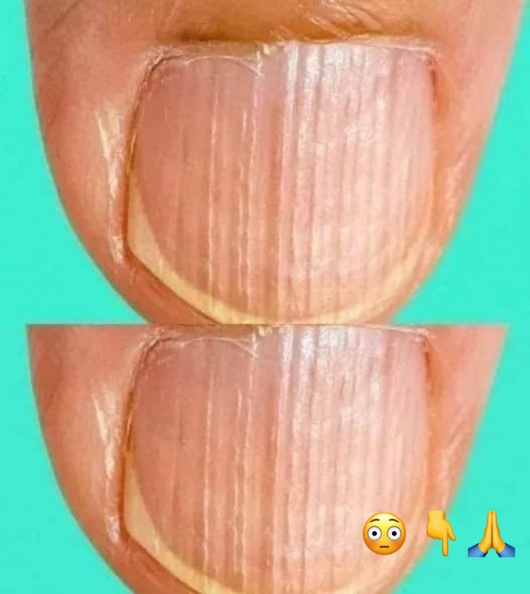 Doctor Reveals 7 Health Issues Hidden in Your Nails