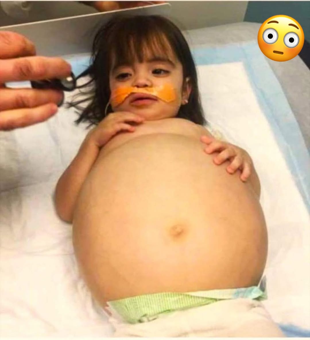 Little girl who looked 8 months’ pregnant because of deadly disease is saved thanks to dad’s kidney donation