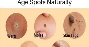 Natural remedies for treating age spots, moles, skin tags, warts, and blackheads