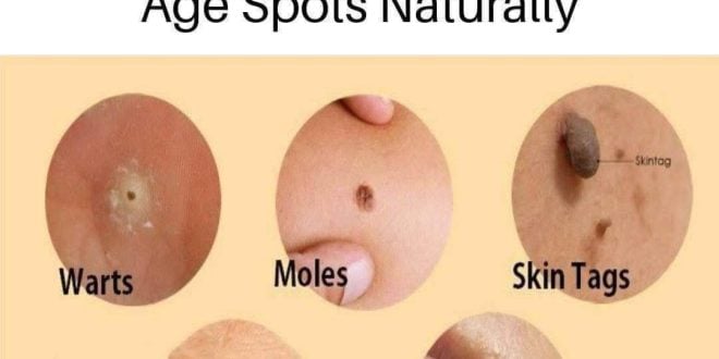 Natural remedies for treating age spots, moles, skin tags, warts, and blackheads