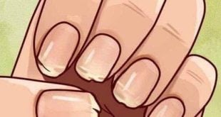 Doctor Reveals 7 Health Issues Hidden in Your Nails