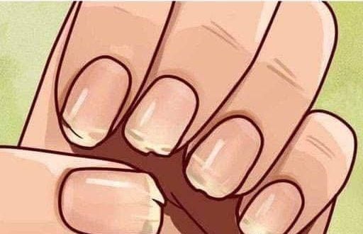 Doctor Reveals 7 Health Issues Hidden in Your Nails