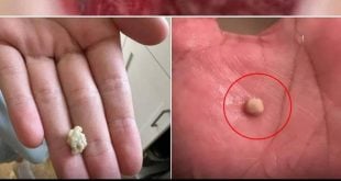 Here’s what you need to know about tonsil stones – the weird pimple-like growths in your throat