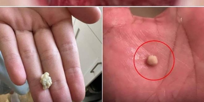 Here’s what you need to know about tonsil stones – the weird pimple-like growths in your throat