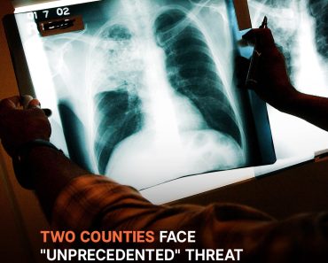 Kansas Tuberculosis Outbreak, Largest in US History, Hits 67 Active Cases Across Two Counties – Latest Details