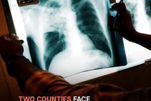 Kansas Tuberculosis Outbreak, Largest in US History, Hits 67 Active Cases Across Two Counties – Latest Details