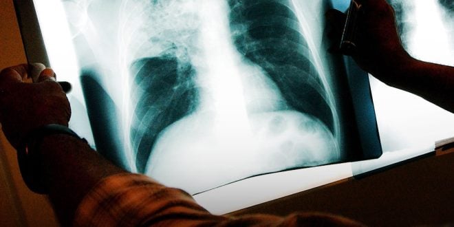 Kansas Tuberculosis Outbreak, Largest in US History, Hits 67 Active Cases Across Two Counties – Latest Details