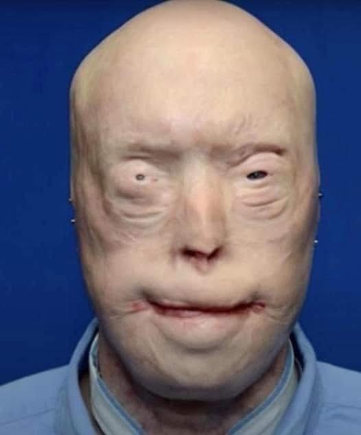 Patrick Hardison received a new face after third-degree burns, this is him today