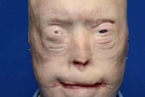 Patrick Hardison received a new face after third-degree burns, this is him today