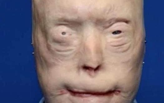 Patrick Hardison received a new face after third-degree burns, this is him today