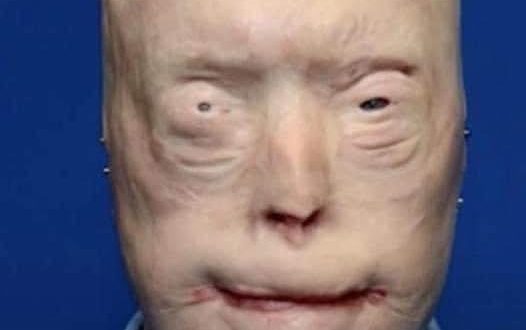 Patrick Hardison received a new face after third-degree burns, this is him today