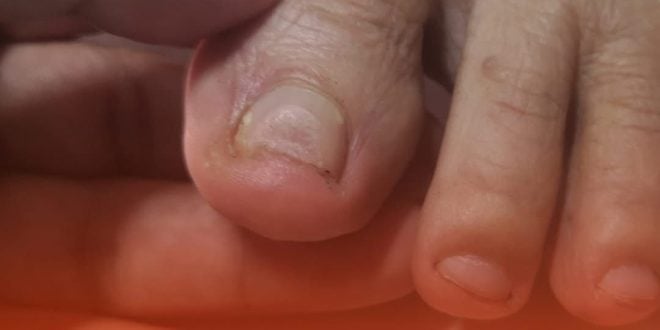 Pharmacist reveals two warning signs of silent killer that you might spot in your feet